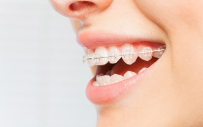 L’ORTHODONTIE POUR ADULTES